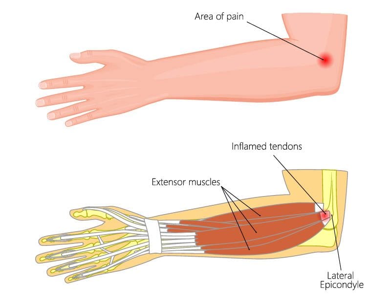 lateral epicondylitis